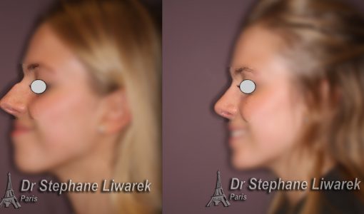 rhinoplastie-bosse du nez