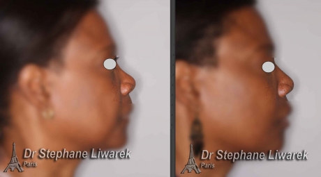 rhinoplastie-d-augmentation